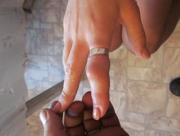 В Воронеже спасатели сняли кольцо с опухшего пальца девушки