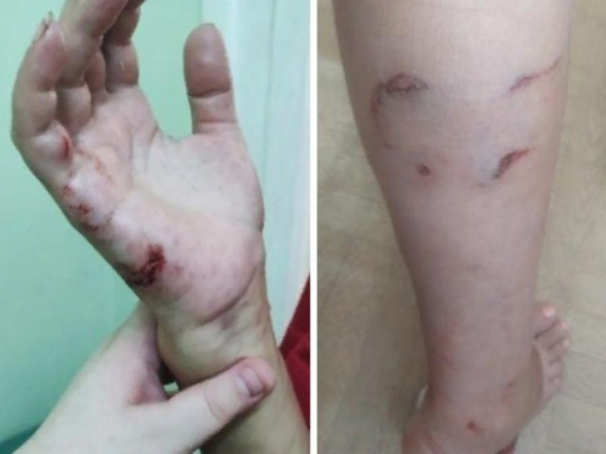 «Заберите, чтобы потом не плакать»: дочь укушенной женщины в Воронеже намерена вызвать отлов собак 