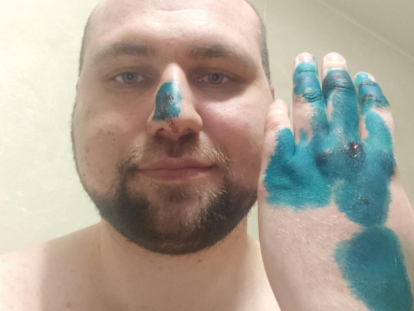 «Лежу на асфальте под дождём»: адвокат из Воронежа рассказал, как его сбила машина