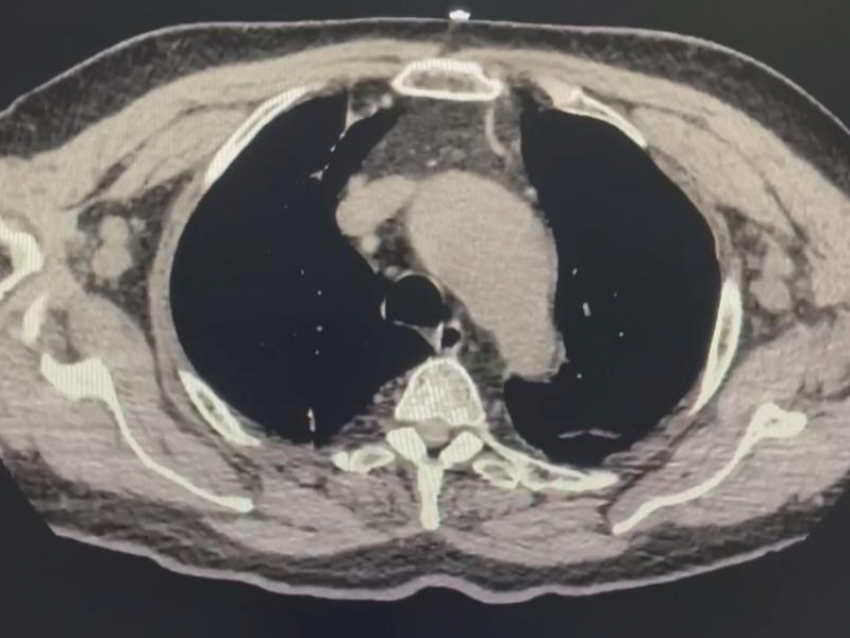 Крайне опасную болезнь сердца у пожилого мужчины удалось вылечить воронежским врачам