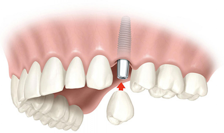 Имплантация зубов в Москве