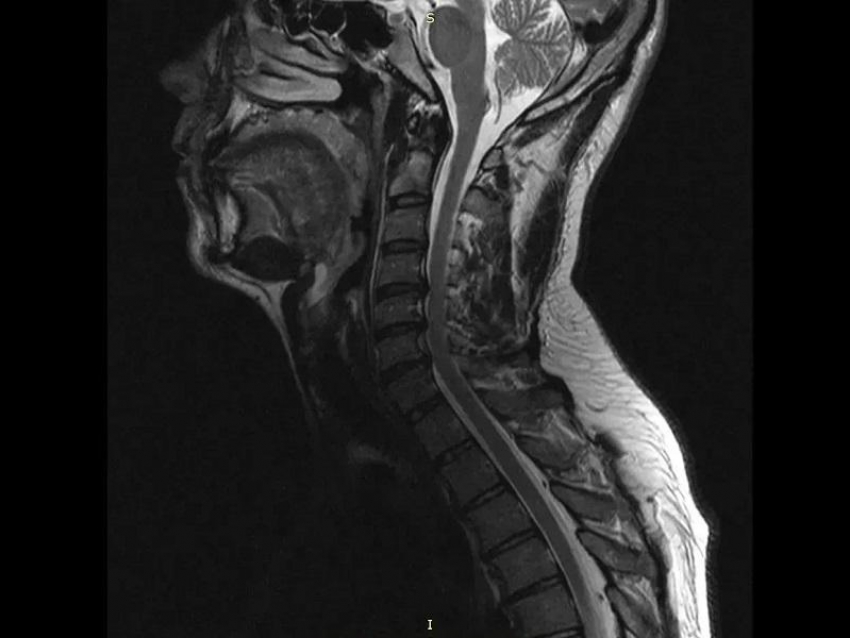 Титановые конструкции врачи вживили в позвоночник воронежца для работы его рук 