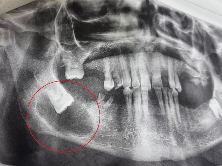 Воронежец много лет ходил с зубом, который рос горизонтально