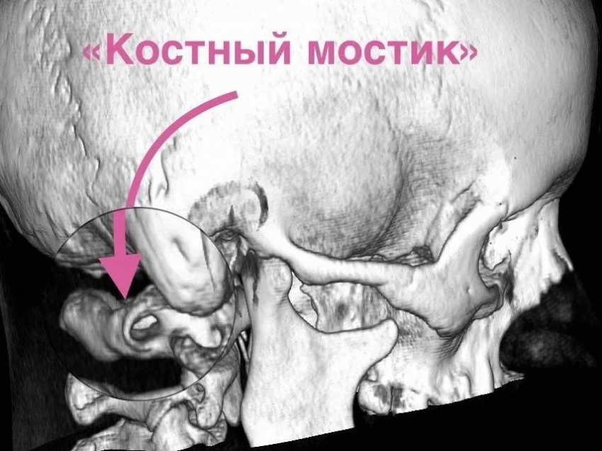 Жила в аду 15 лет: воронежские нейрохирурги освободили мозг девушки от костного плена