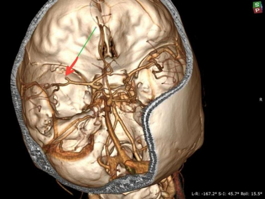 Стрессы на работе довели 35-летнюю женщину до инсульта в Воронеже 