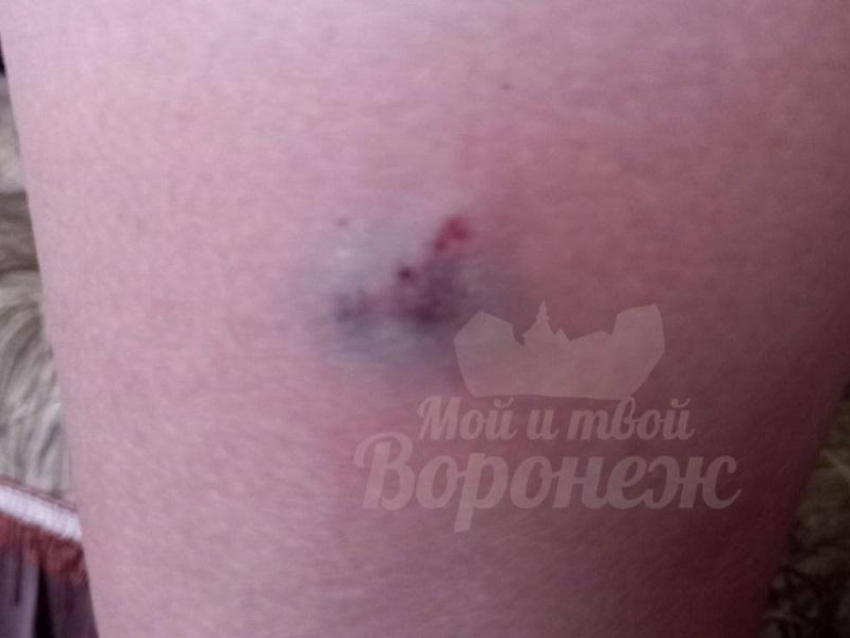 Последствия нападения собаки на 9-летнего мальчика показали в Воронеже