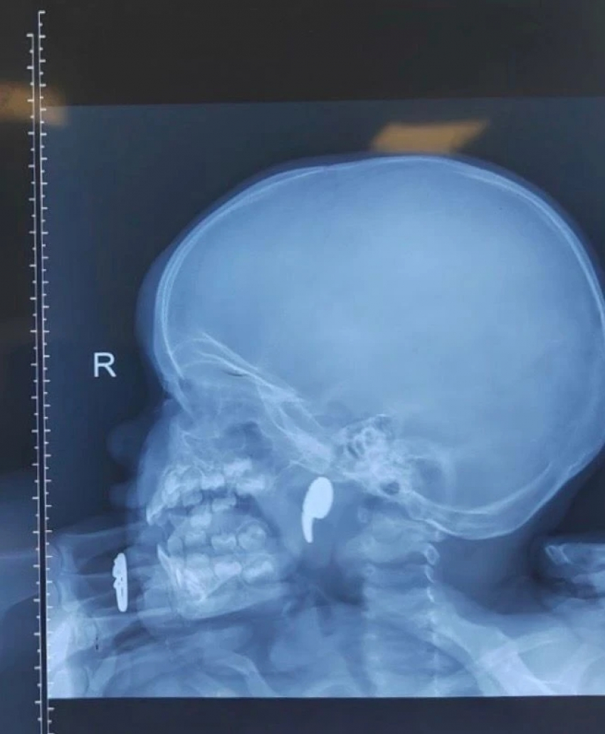 1,5-годовалая малышка едва не задохнулась из-за магнита в Воронеже