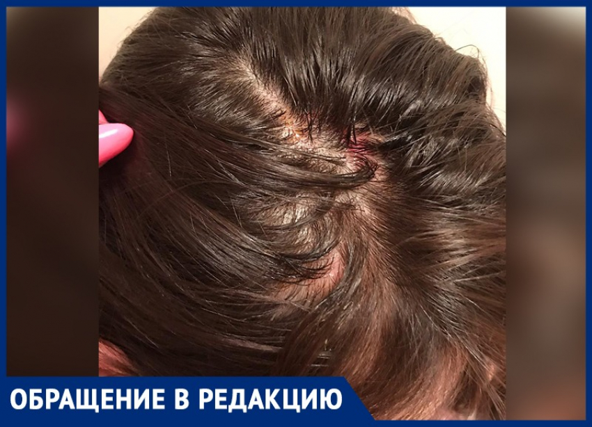 Кроваво-гнойными волдырями покрылась голова девушки после похода в студию красоты в Воронеже