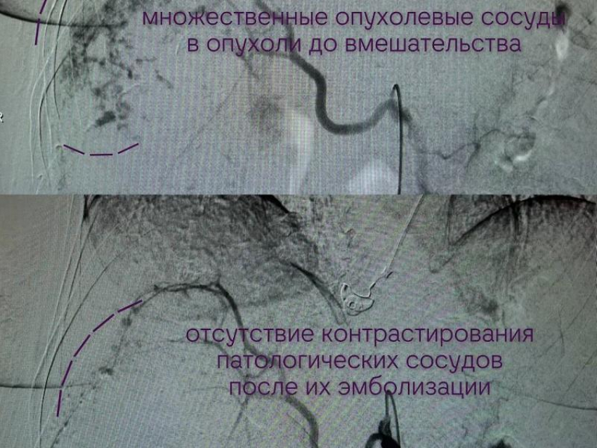 Воронежские врачи удалили из женщины гигантскую опухоль, занимавшую почти всю её печень 