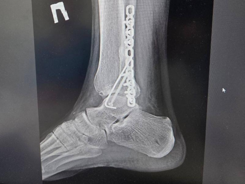 Дело закрыли: воронежец ищет свидетелей ДТП, в котором авто сломало ему ногу