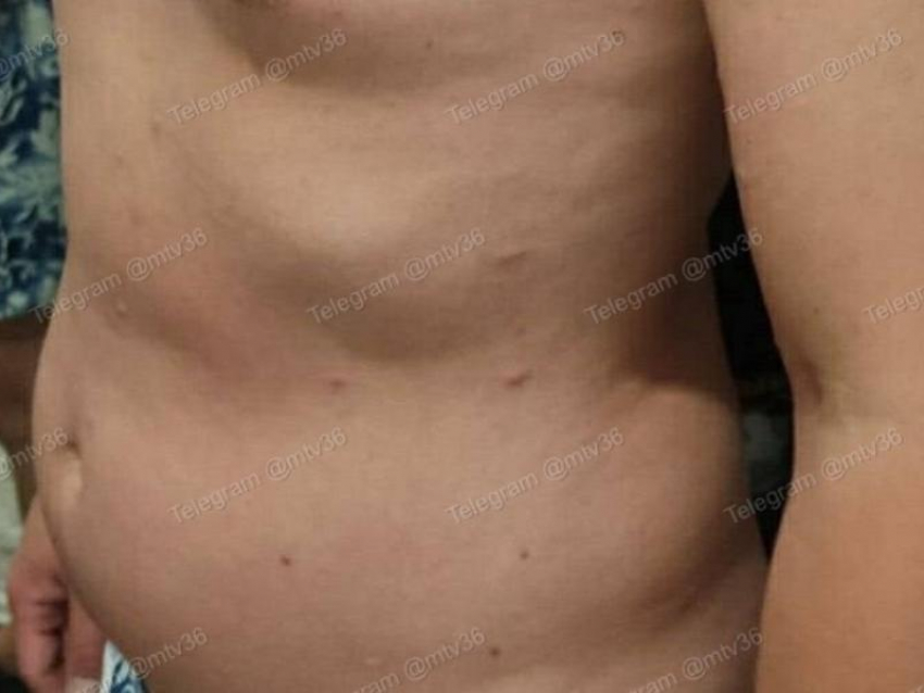 «Ужас»: отвратительные личинки забрались под кожу воронежца 