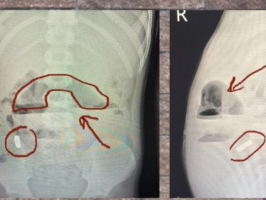 10 магнитов извлекли из брюшной полости 6-летнего малыша в Воронеже
