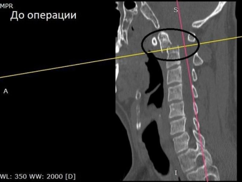 Воронежец упал в подъезде дома и сломал себе шейный позвонок