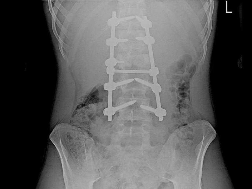 Воронежские врачи вернули 16-летнему подростку возможность ходить после тяжёлой травмы