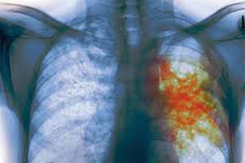 Опыт воронежских врачей в борьбе с туберкулезом приехали изучать специалисты ВОЗ
