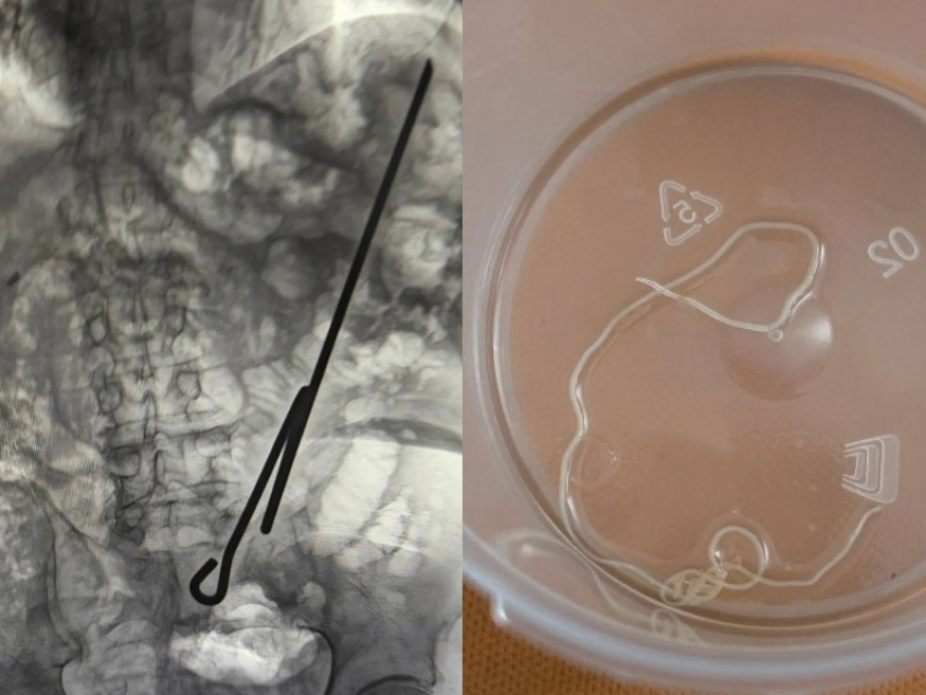 «Повезло, что был голоден»: паразита и самодельный инструмент вырезали из двух мужчин в Воронеже 