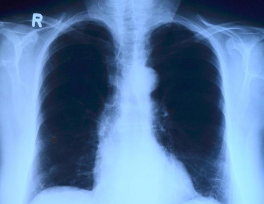 Воронежцев приглашают поддержать людей с тяжелым заболеванием легких