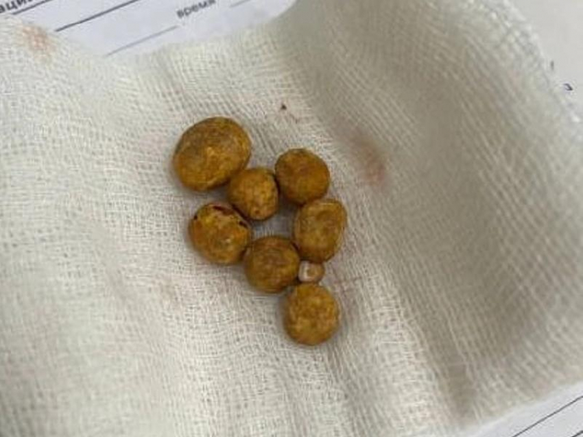 Пытавшегося вылечить кровь в моче настоями трав мужчину срочно прооперировали в Воронеже