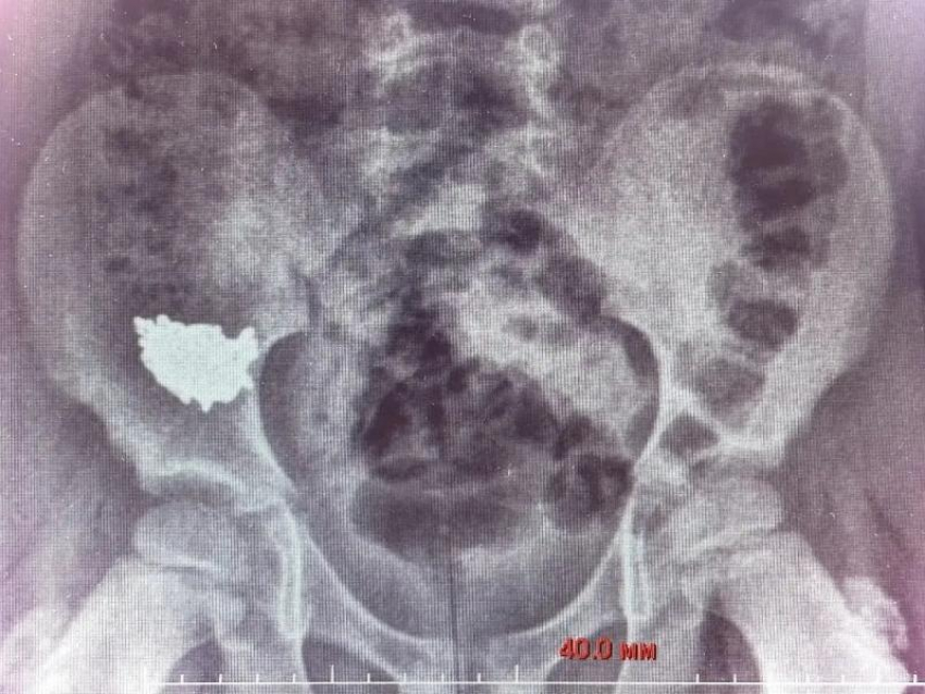 Ребёнок случайно проглотил 20-сантиметровую цепочку – его пришлось оперировать в Воронеже