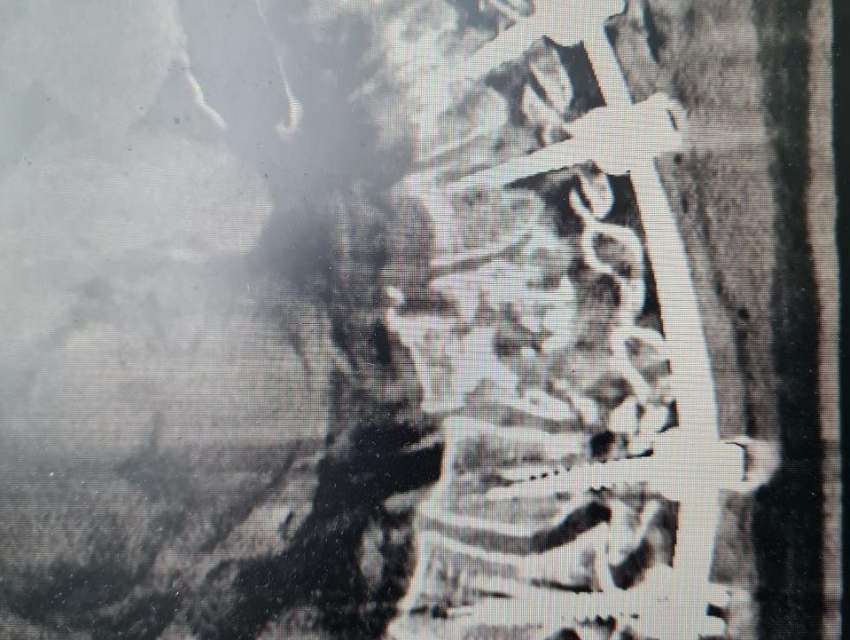 Сломанный позвоночник и угроза инвалидности: как в Воронеже поставили на ноги жертву ДТП